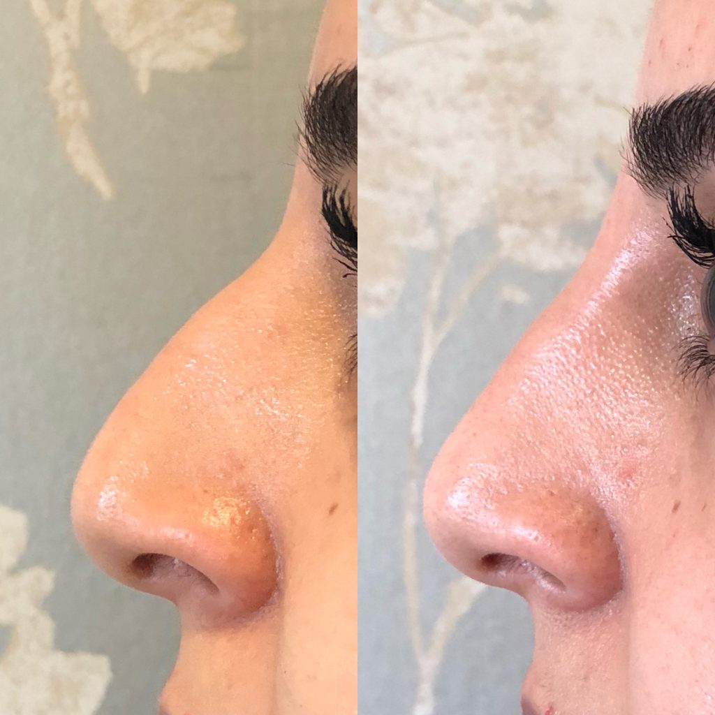 Nose Job before and after